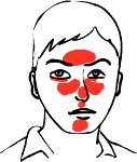 Rosacea Rosazea